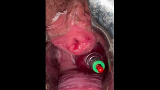 Aspirazione della bocca uterina