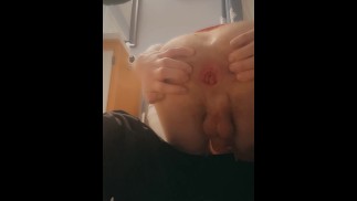 Secuelas de fisting